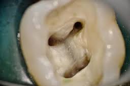Lower molar